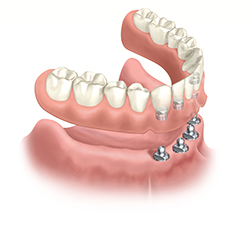 Removable implant overdenture
