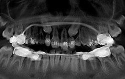 Uncovering Impacted Teeth for Ortho