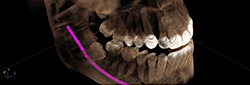 Wisdom teeth removal nerve mapping